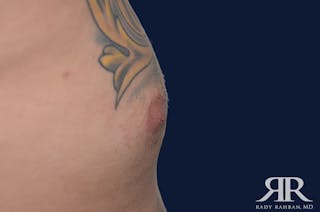 Nipple Reduction Before & After Gallery - Patient 810159 - Image 2