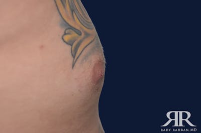 Nipple Reduction Before & After Gallery - Patient 810159 - Image 2
