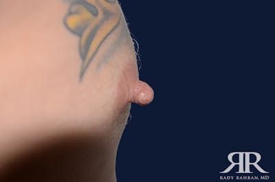 Nipple Reduction Before & After Gallery - Patient 810159 - Image 1