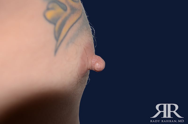 Nipple Reduction Before & After Gallery - Patient 810159 - Image 1