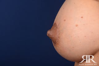 Nipple Reduction Before & After Gallery - Patient 366256 - Image 2