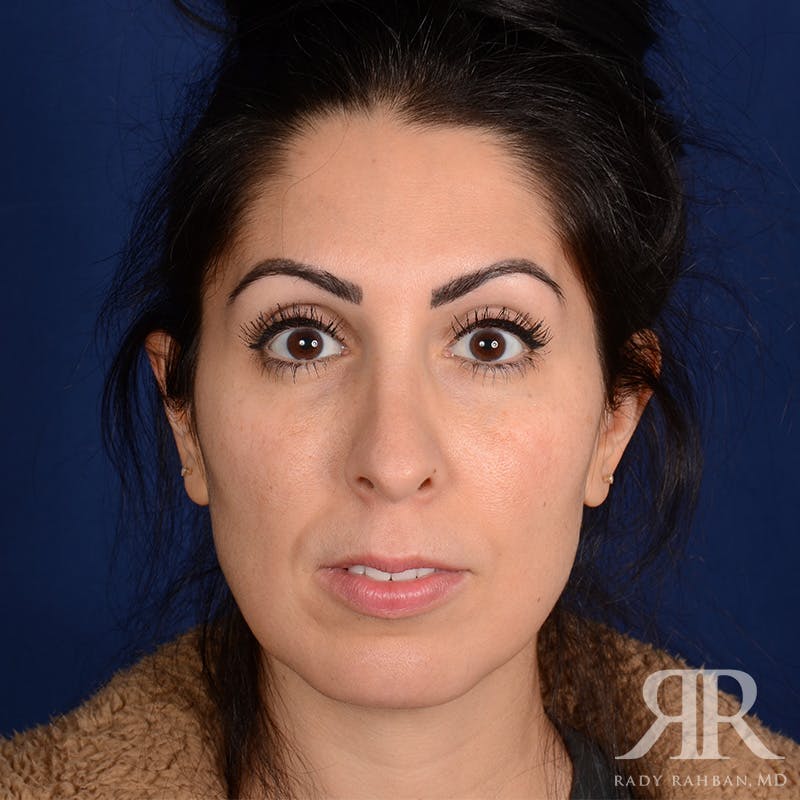 Chin Augmentation Before & After Gallery - Patient 342105 - Image 1
