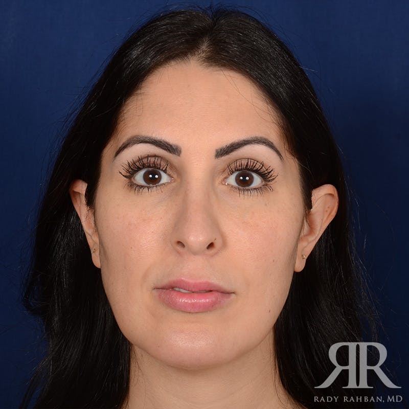 Chin Augmentation Before & After Gallery - Patient 342105 - Image 2