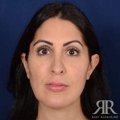 Chin Augmentation Before & After Gallery - Patient 342105 - Image 2