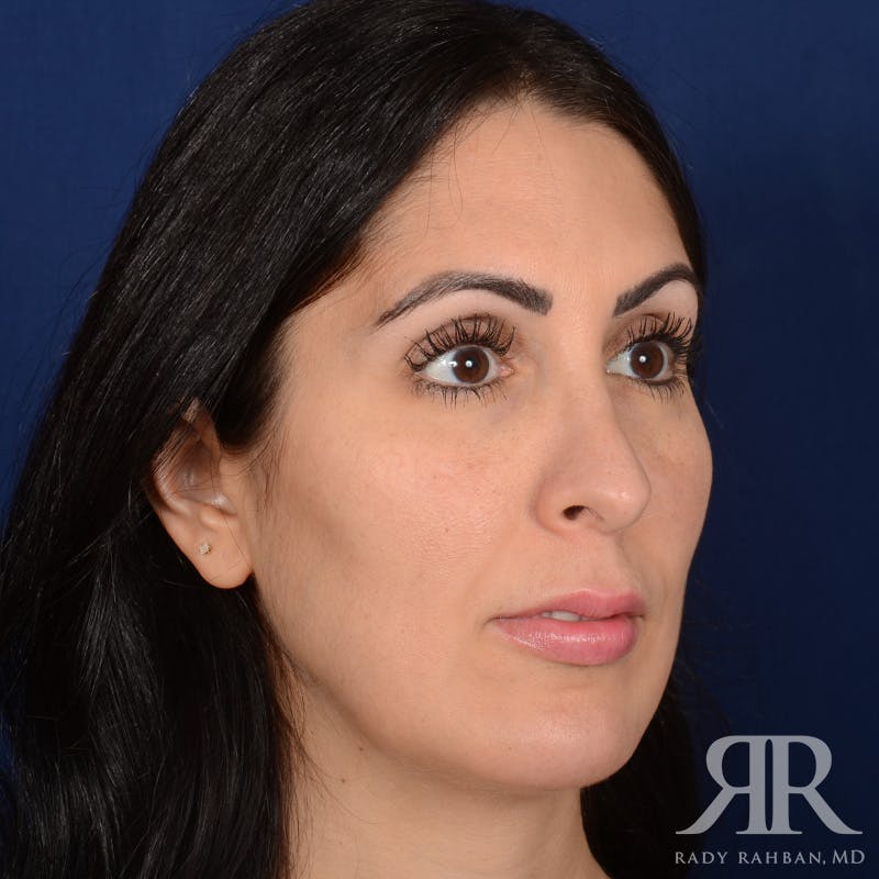 Chin Augmentation Before & After Gallery - Patient 342105 - Image 4