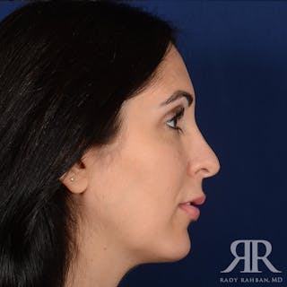 Chin Augmentation Before & After Gallery - Patient 342105 - Image 6
