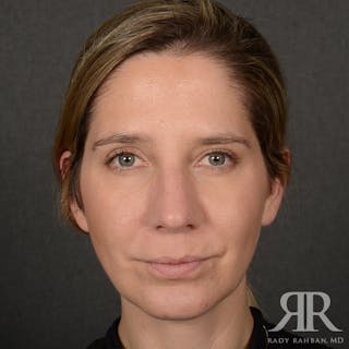 Chin Augmentation Before & After Gallery - Patient 300364 - Image 2