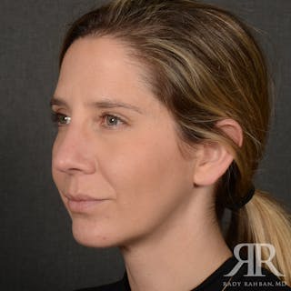 Chin Augmentation Before & After Gallery - Patient 300364 - Image 4