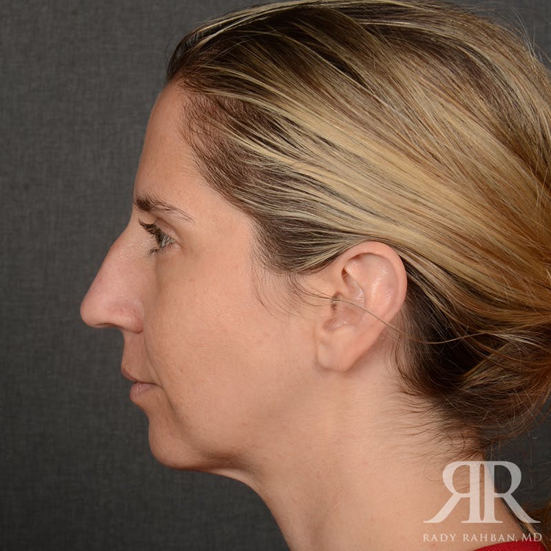 Chin Augmentation Before & After Gallery - Patient 300364 - Image 5