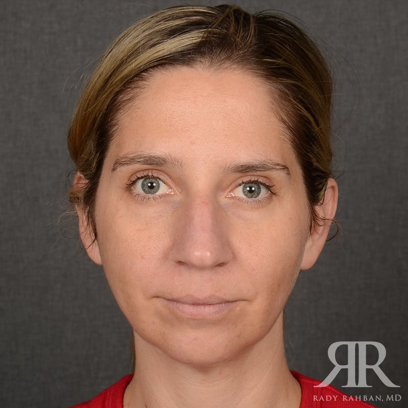 Chin Augmentation Before & After Gallery - Patient 300364 - Image 1