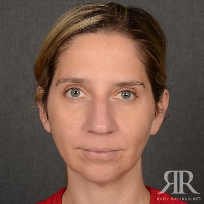 Chin Augmentation Before & After Gallery - Patient 300364 - Image 1