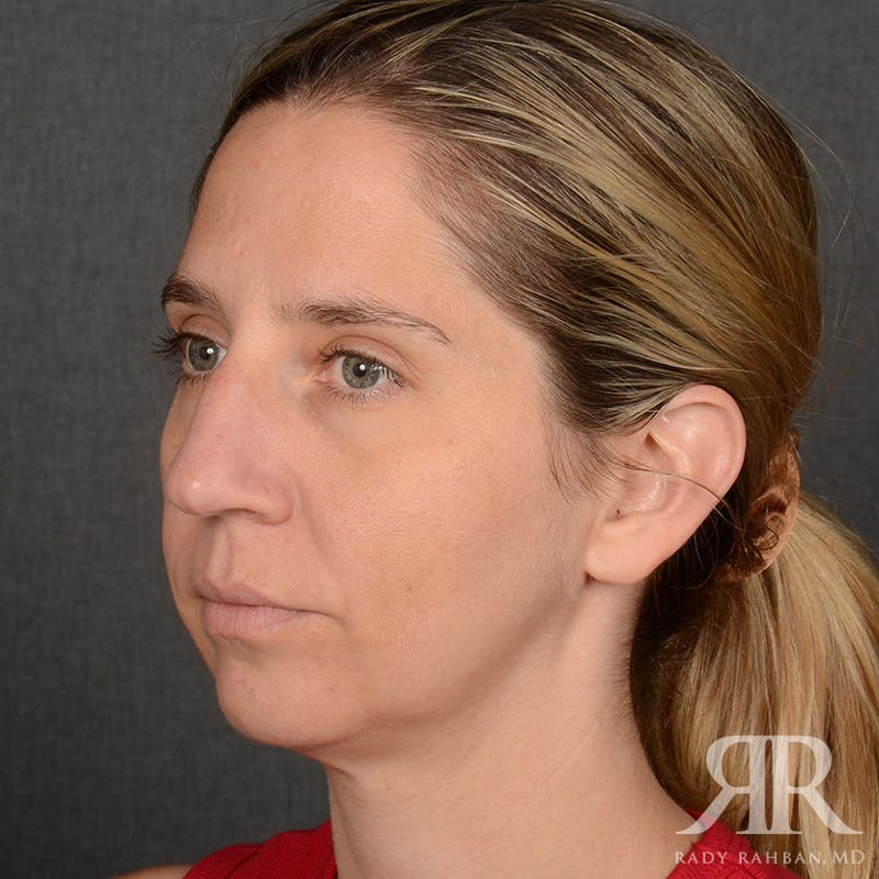 Chin Augmentation Before & After Gallery - Patient 300364 - Image 3
