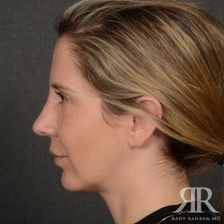 Chin Augmentation Before & After Gallery - Patient 300364 - Image 6
