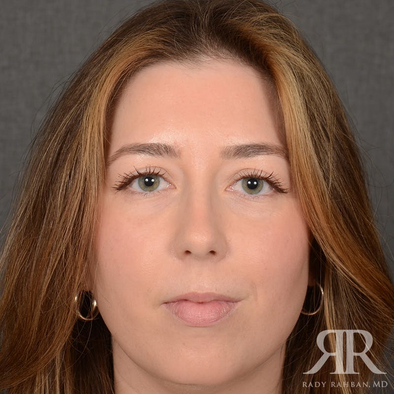Chin Augmentation Before & After Gallery - Patient 258870 - Image 1