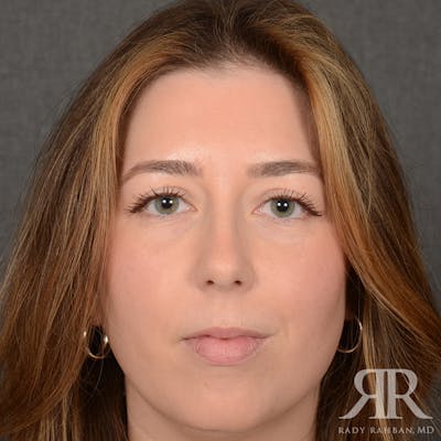 Chin Augmentation Before & After Gallery - Patient 258870 - Image 1