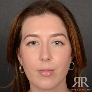 Chin Augmentation Before & After Gallery - Patient 258870 - Image 2
