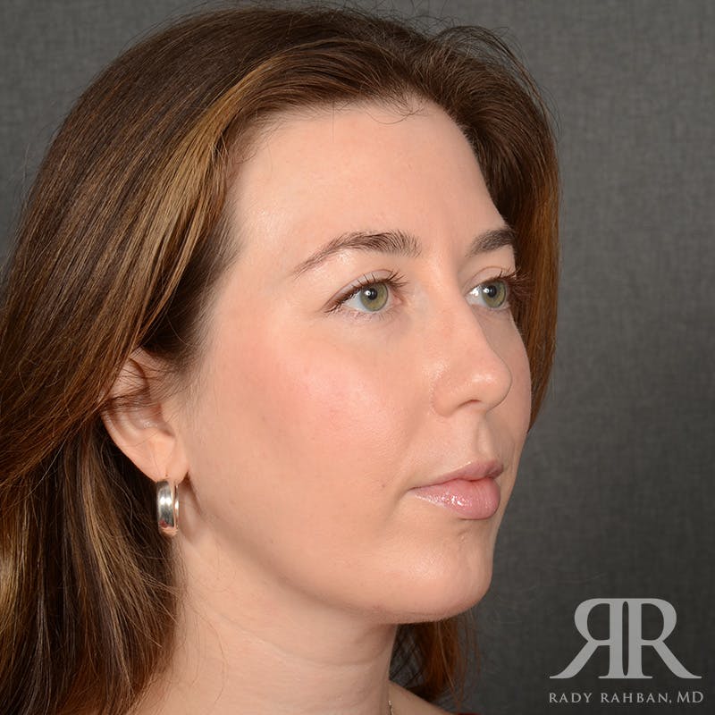 Chin Augmentation Before & After Gallery - Patient 258870 - Image 4