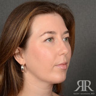 Chin Augmentation Before & After Gallery - Patient 258870 - Image 4