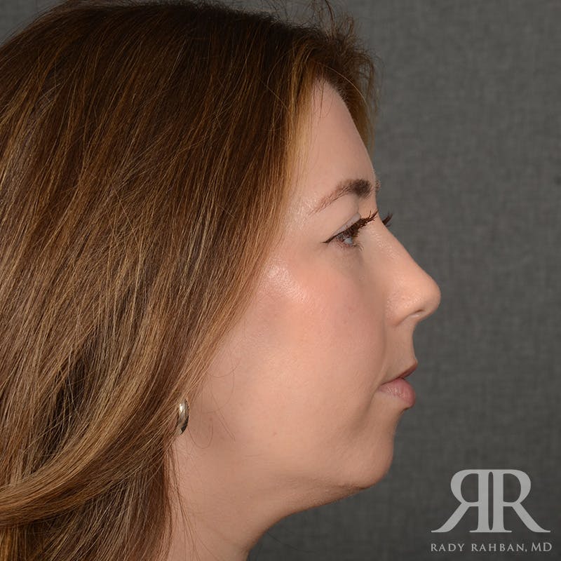 Chin Augmentation Before & After Gallery - Patient 258870 - Image 5