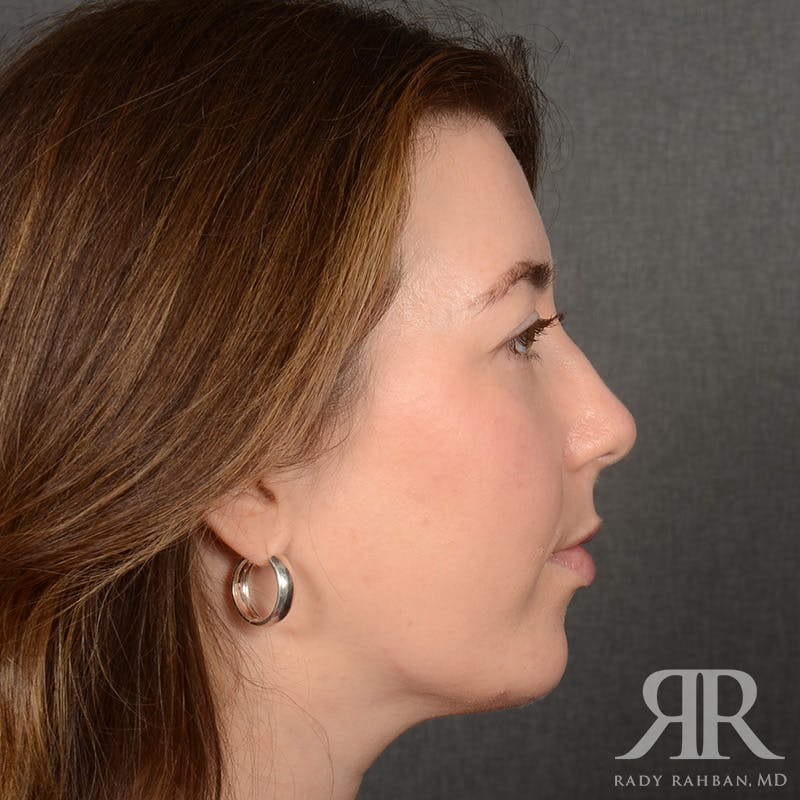 Chin Augmentation Before & After Gallery - Patient 258870 - Image 6