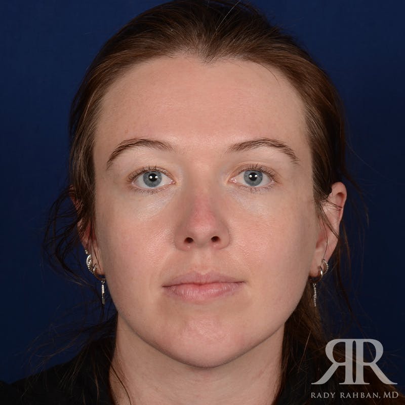 Chin Augmentation Before & After Gallery - Patient 261415 - Image 1
