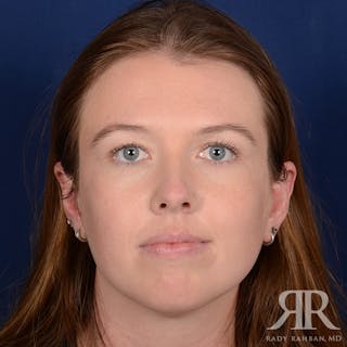 Chin Augmentation Before & After Gallery - Patient 261415 - Image 2