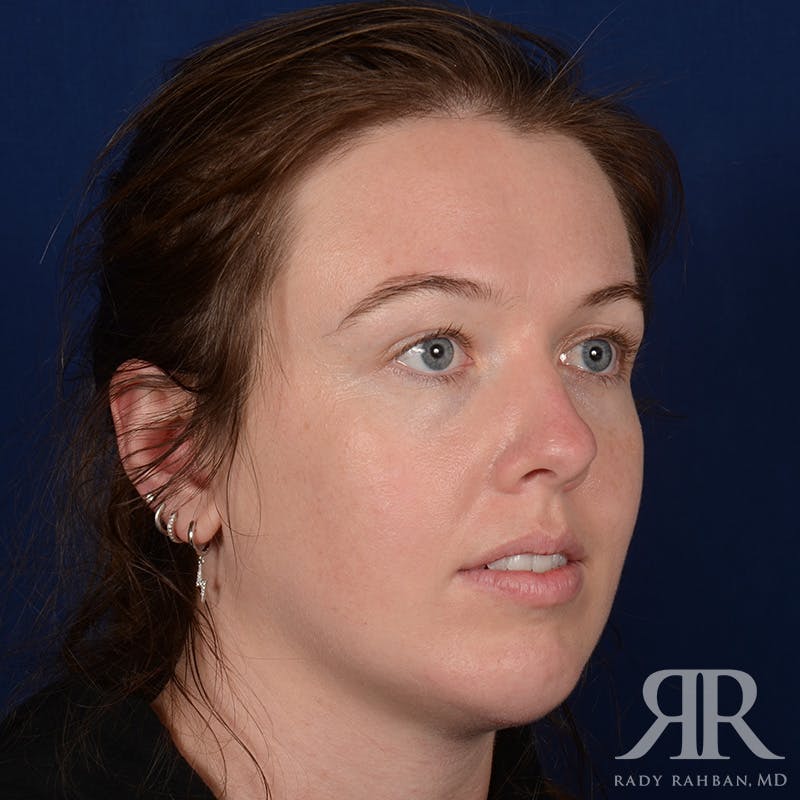 Chin Augmentation Before & After Gallery - Patient 261415 - Image 3