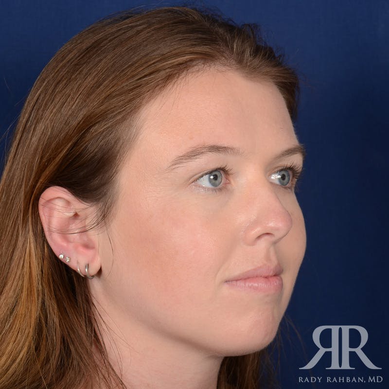 Chin Augmentation Before & After Gallery - Patient 261415 - Image 4