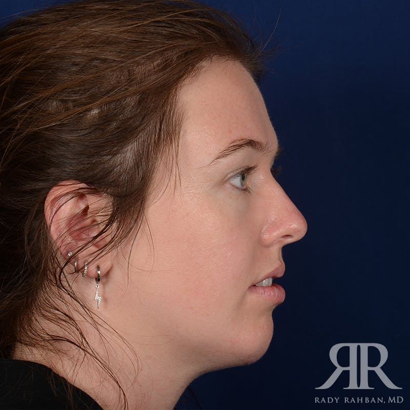 Chin Augmentation Before & After Gallery - Patient 261415 - Image 5