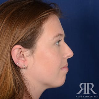 Chin Augmentation Before & After Gallery - Patient 261415 - Image 6