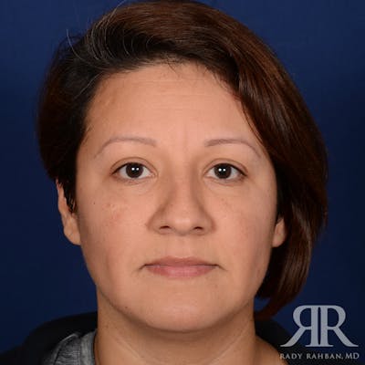 Chin Augmentation Before & After Gallery - Patient 291285 - Image 1