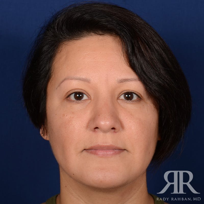 Chin Augmentation Before & After Gallery - Patient 291285 - Image 2