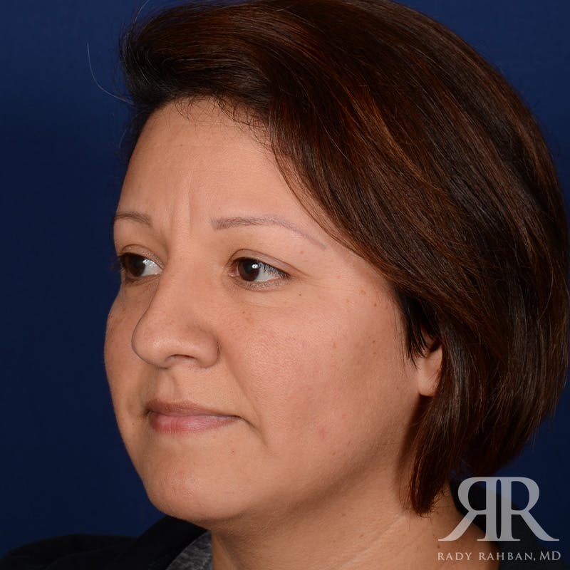 Chin Augmentation Before & After Gallery - Patient 291285 - Image 3