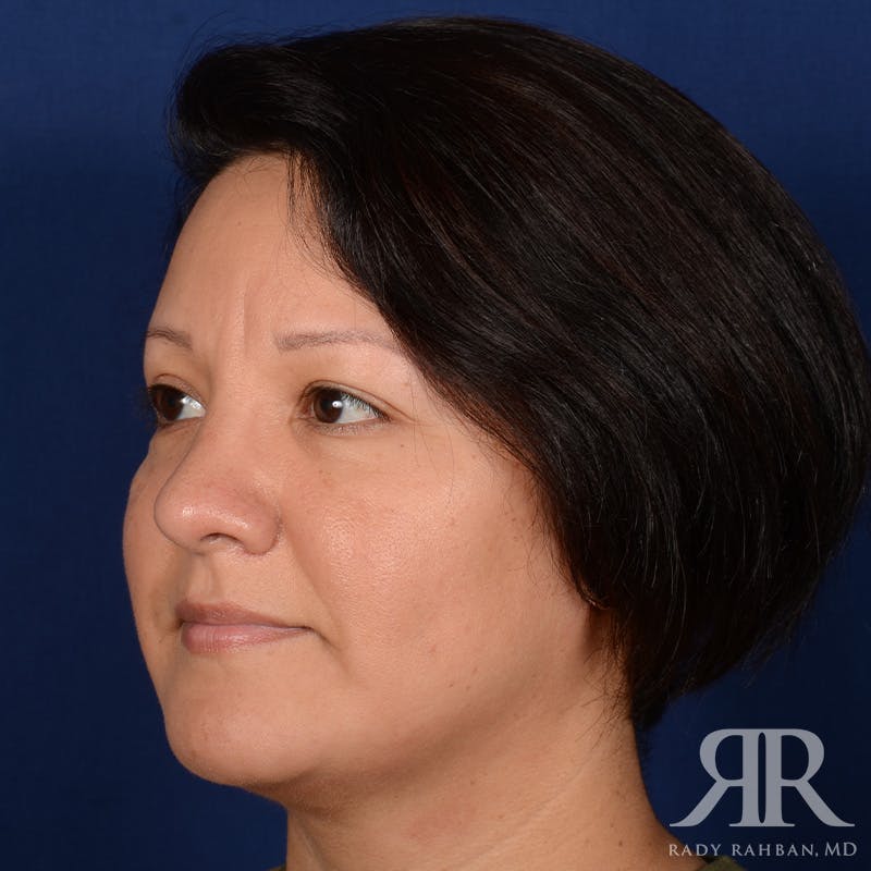 Chin Augmentation Before & After Gallery - Patient 291285 - Image 4