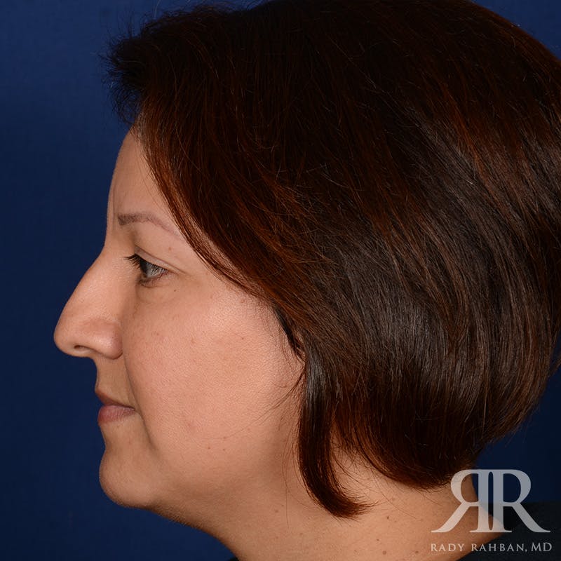 Chin Augmentation Before & After Gallery - Patient 291285 - Image 5
