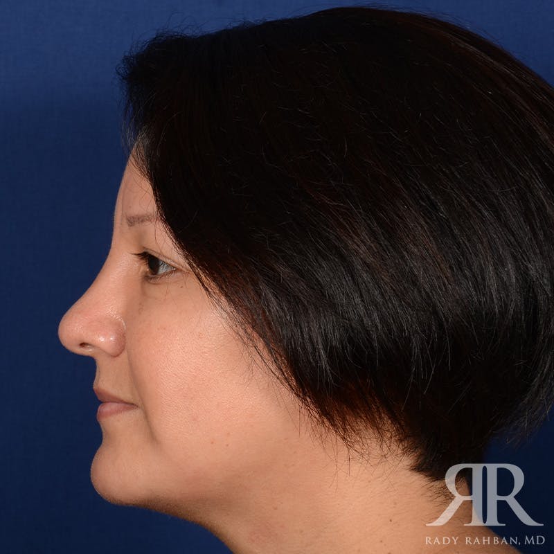 Chin Augmentation Before & After Gallery - Patient 291285 - Image 6