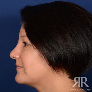 Chin Augmentation Before & After Gallery - Patient 291285 - Image 6