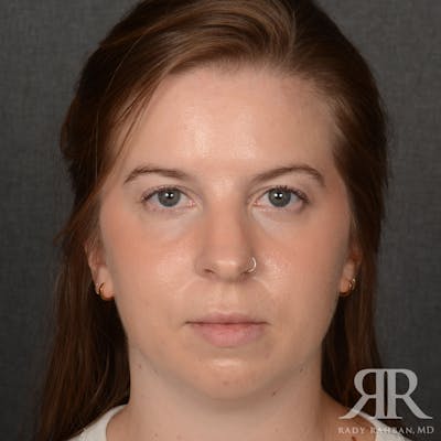 Chin Augmentation Before & After Gallery - Patient 203892 - Image 1