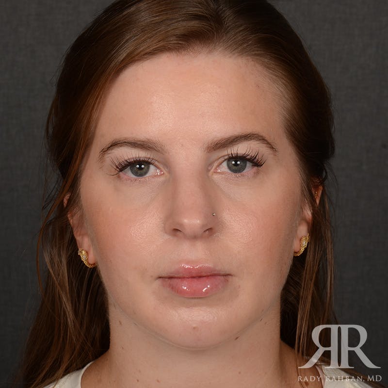 Chin Augmentation Before & After Gallery - Patient 203892 - Image 2