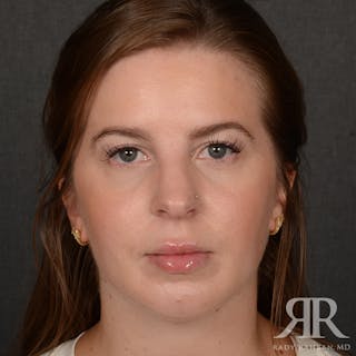 Chin Augmentation Before & After Gallery - Patient 203892 - Image 2