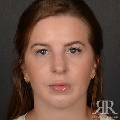 Chin Augmentation Before & After Gallery - Patient 203892 - Image 2