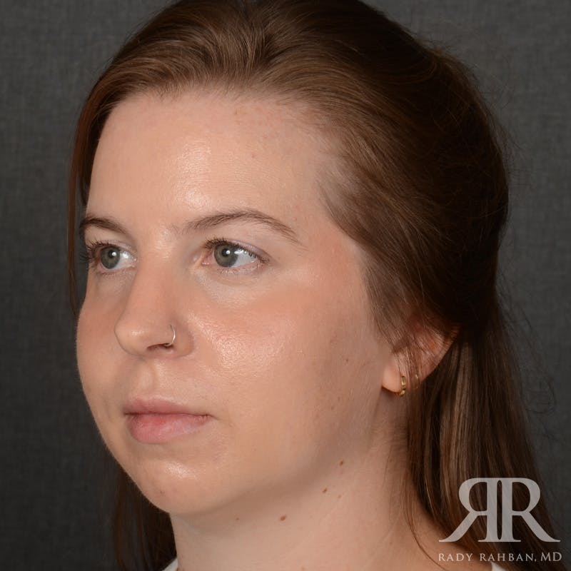 Chin Augmentation Before & After Gallery - Patient 203892 - Image 3
