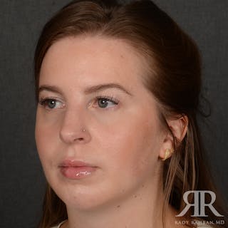 Chin Augmentation Before & After Gallery - Patient 203892 - Image 4