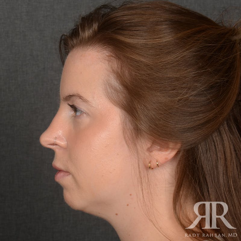 Chin Augmentation Before & After Gallery - Patient 203892 - Image 5
