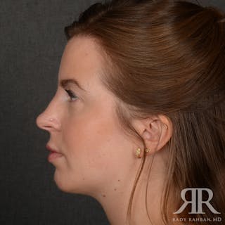 Chin Augmentation Before & After Gallery - Patient 203892 - Image 6
