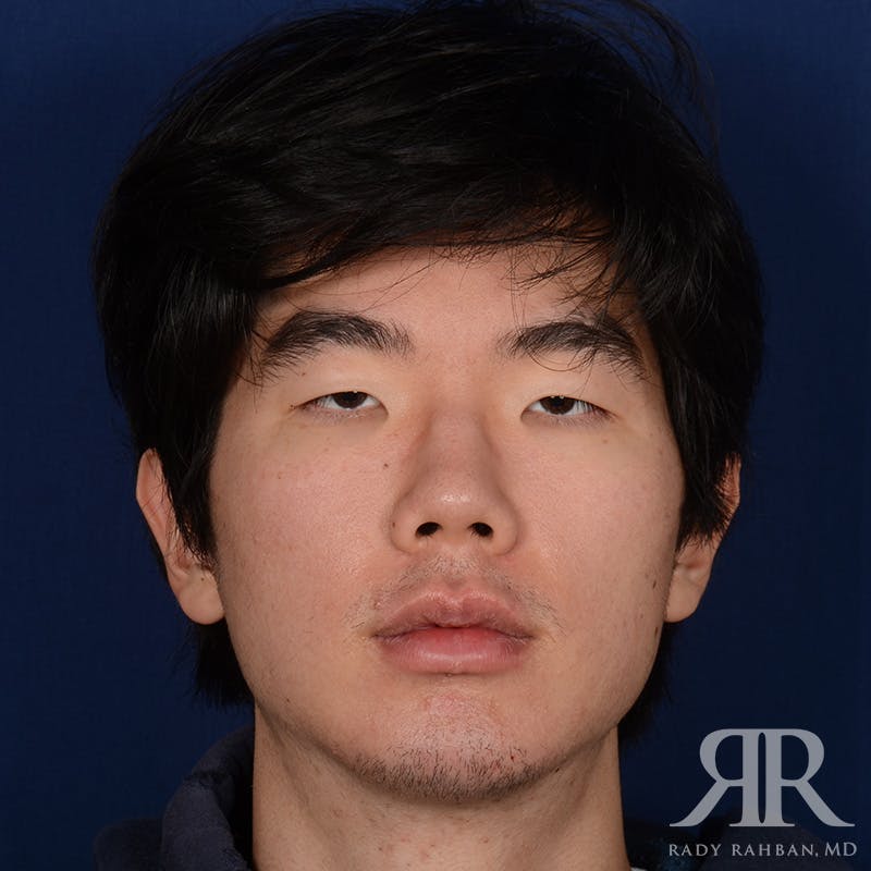 Chin Augmentation Before & After Gallery - Patient 309121 - Image 1