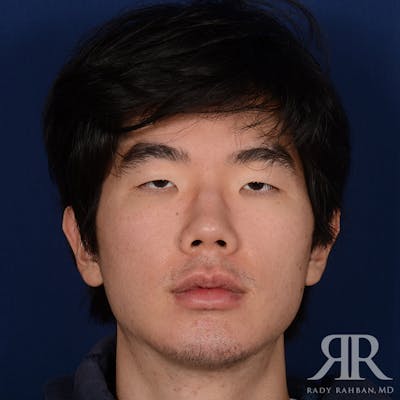 Chin Augmentation Before & After Gallery - Patient 309121 - Image 1