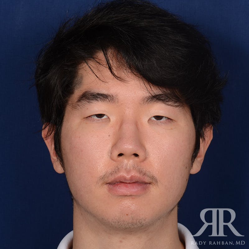 Chin Augmentation Before & After Gallery - Patient 309121 - Image 2