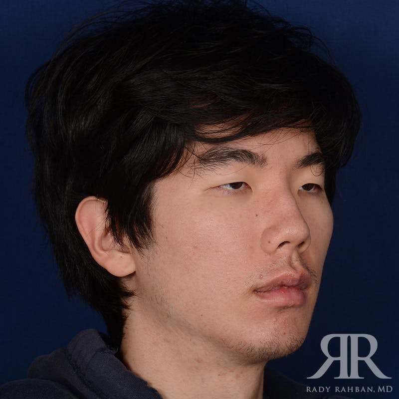 Chin Augmentation Before & After Gallery - Patient 309121 - Image 3