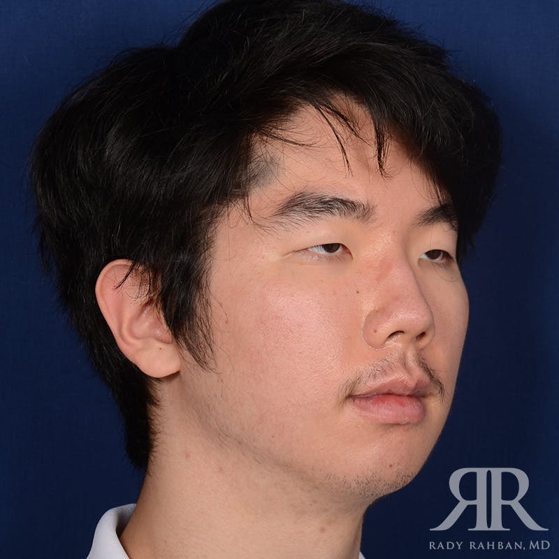 Chin Augmentation Before & After Gallery - Patient 309121 - Image 4